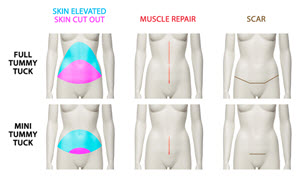 difference between a mini and full abdominoplasty